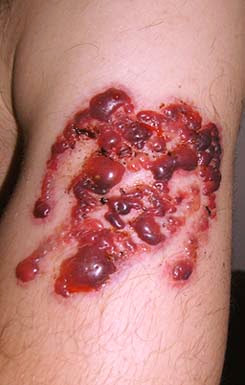 Excision Tattoo Removal images