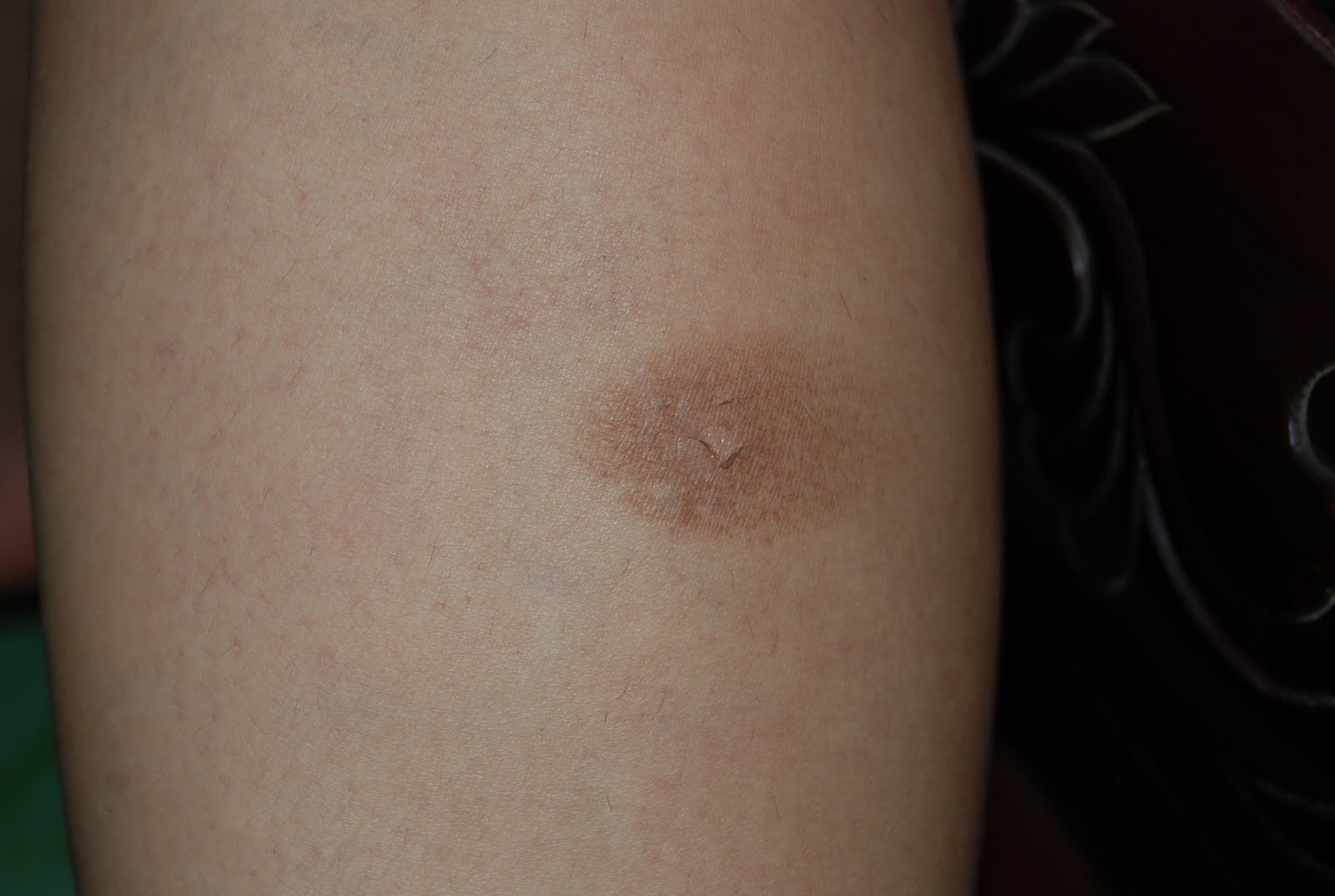 Oh, The Places You'll Go! More bites and other ailments