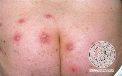 Herpes on The Buttocks | Herpes on Tongue