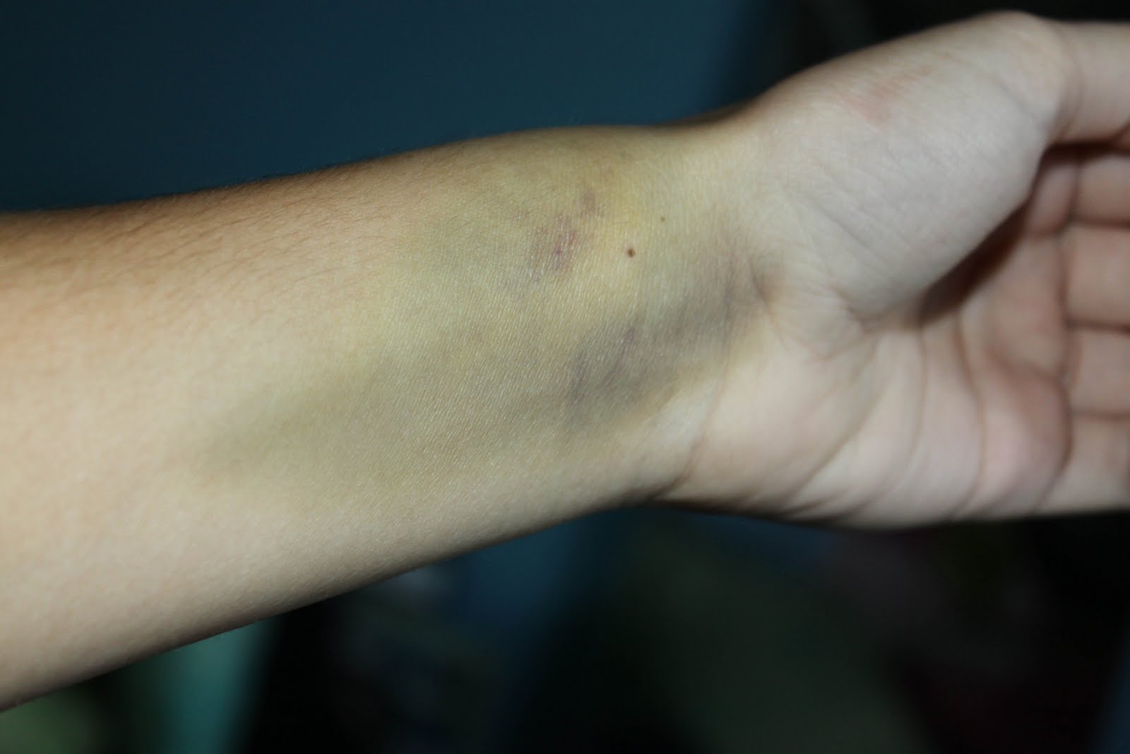 What Are Signs Of Blood Clot In Wrist at Paul Jamison blog