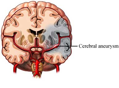 what is a brain aneurysm