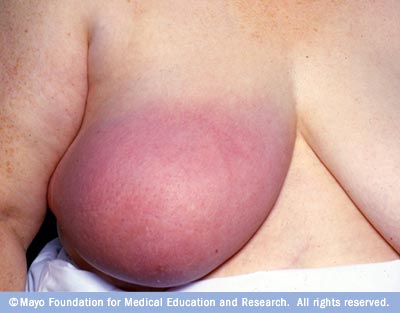 Red Spot On Breast No Lump - Doctor insights on HealthTap