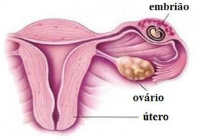 gravidez ectópica