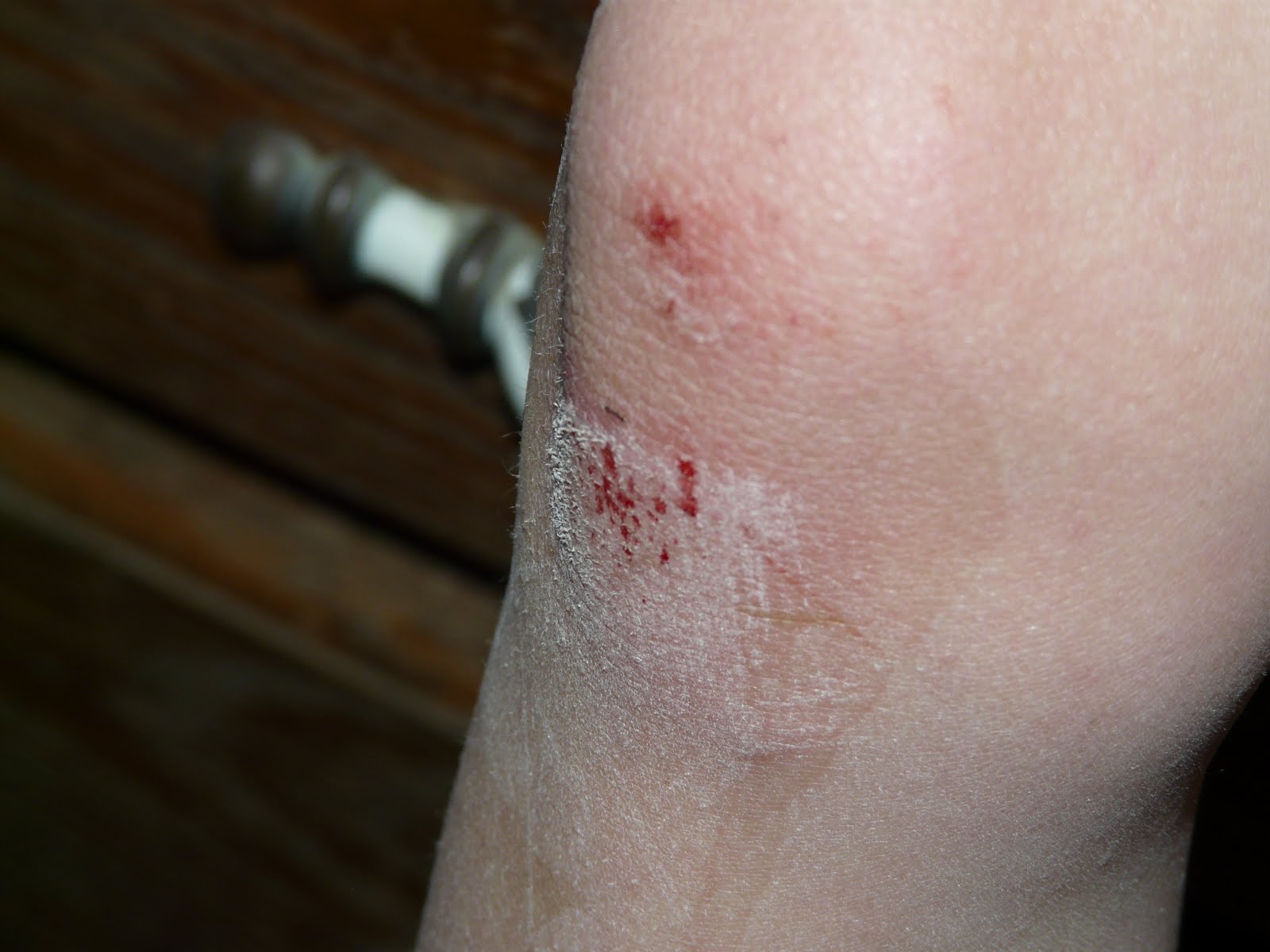 Keeping Up With the Joneses Knee Scrapes Equal Fun In This Family!