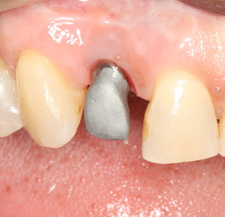 PRÓTESE SOBRE IMPLANTES UFMG: transfer-munhao-coping