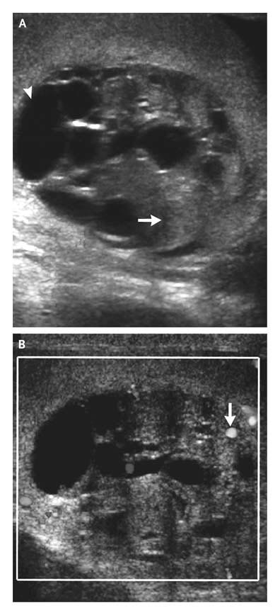 epididimo orquitis tratamiento emedicina diabetes