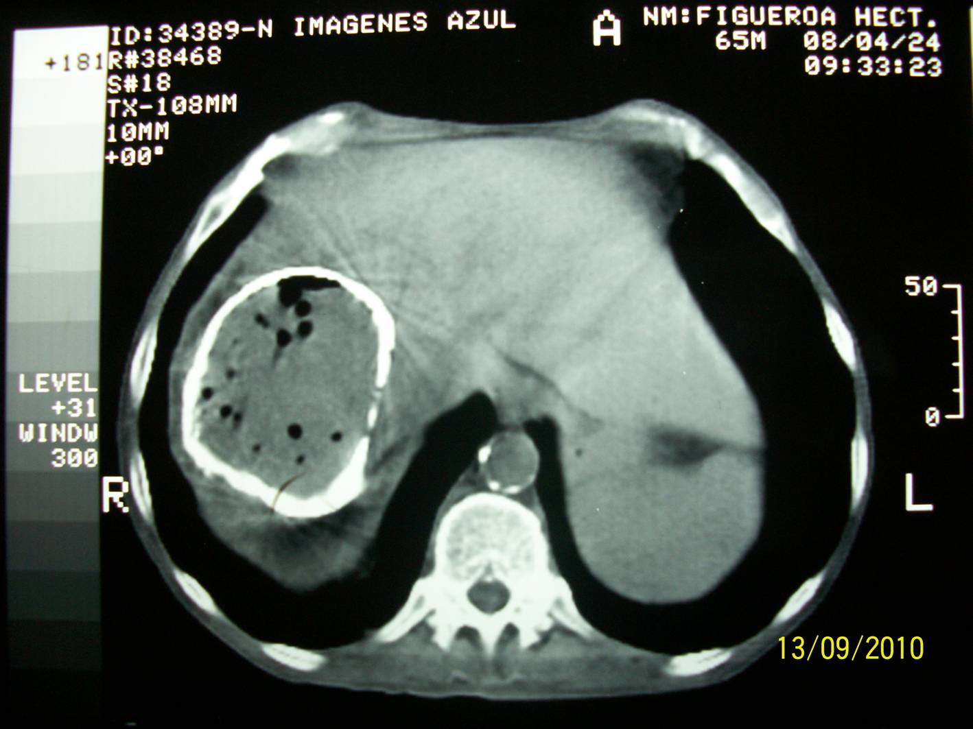 Quiste hepatico simple complicado