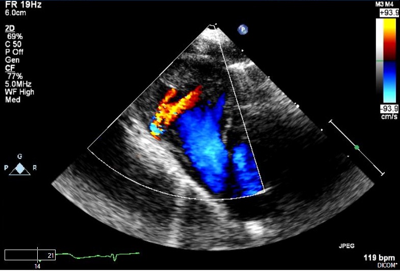 All About Ultrasound: Muscular VSD