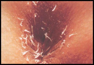 Enterobius vermicularis hospedero, Paraziták az emberi ízületek tünetei és kezelése