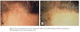 Tretinoin and hair growth