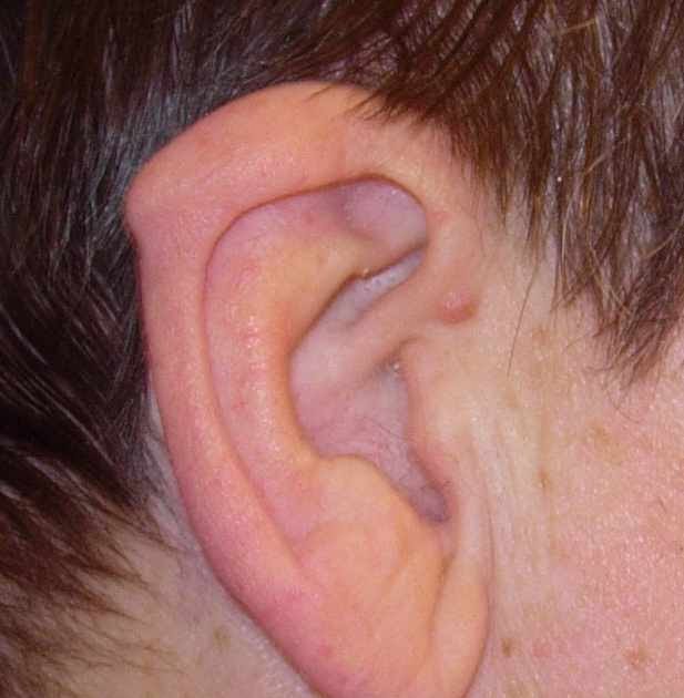 TYWKIWDBI ("TaiWikiWidbee") My "elfin ear" is actually a "Darwin's