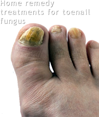 Beauty Tips: Home remedies treatment for toenail fungus