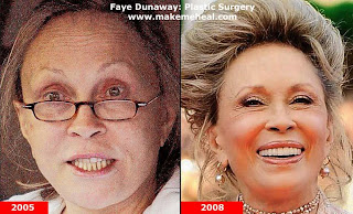 Faye Dunaway Plastic Surgery