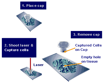 [Laser-capture_microdissection_cartoon.gif]
