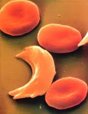 What does sickle cell disease look like?