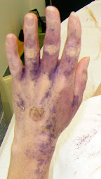 Starch test after Sympathectomy (T2 cut). return of palmar hyperhidrosis 6 months after surgery