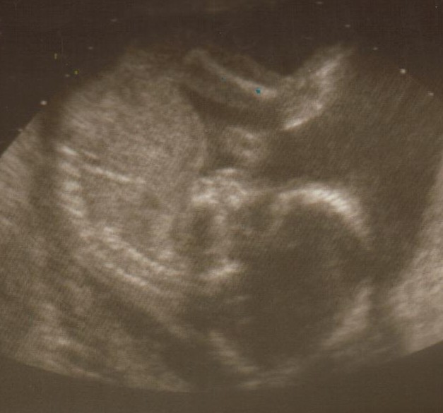 [18+week+ultrasound.jpg]
