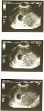 6 Week Ultrasound Pic