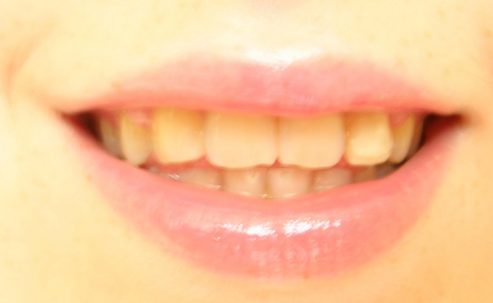 Наращивание кон\ч\сницы зуба. Желтые зубы во сне. Желтые зубы во сне. Желтые зубы во сне. 50 cent грилзы.