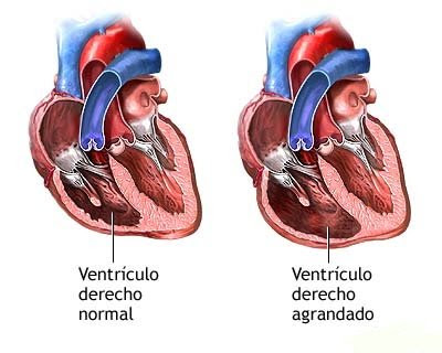 Regurgitación tricuspídea leve moderada hipertensión severa Regurgitación tricuspídea leve moderada hipertensión severa