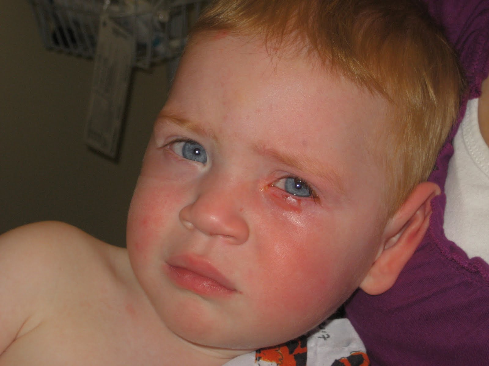 Day by Day Cooper's Eye Surgery