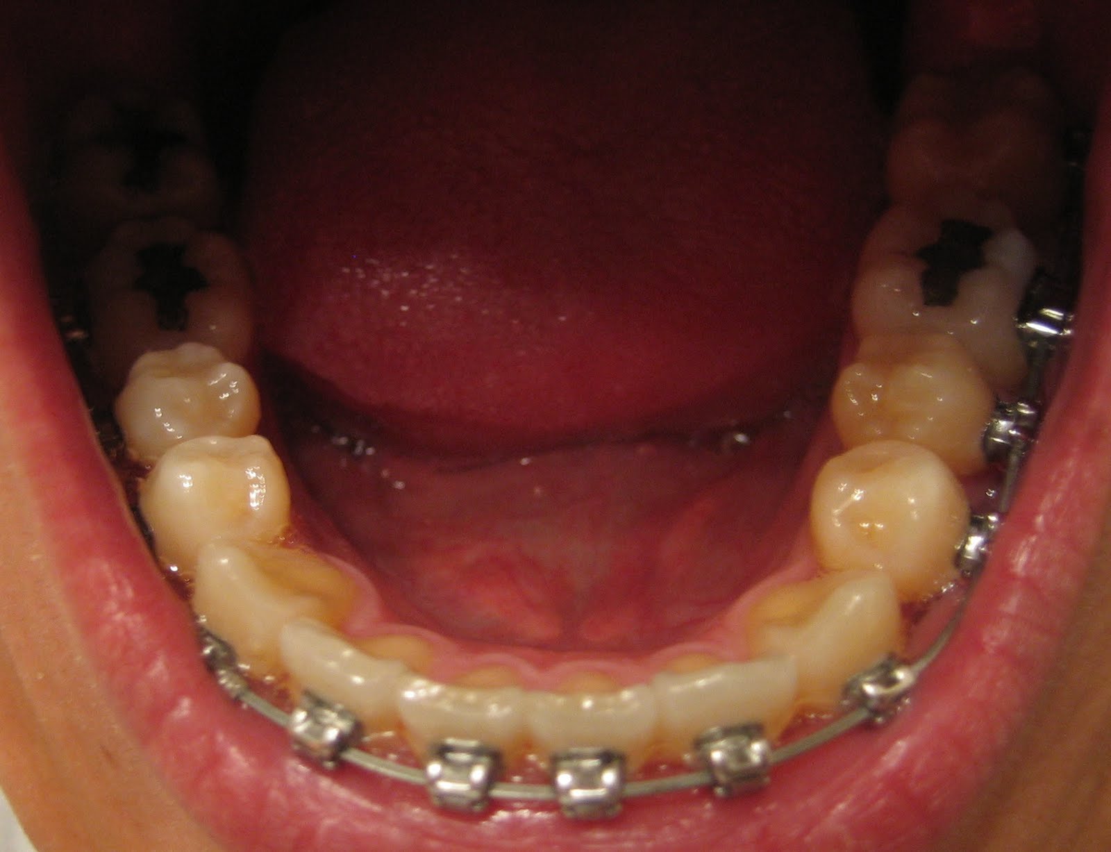 My Journey with the Damon Braces Week 33 Ortho Follow up & New wires
