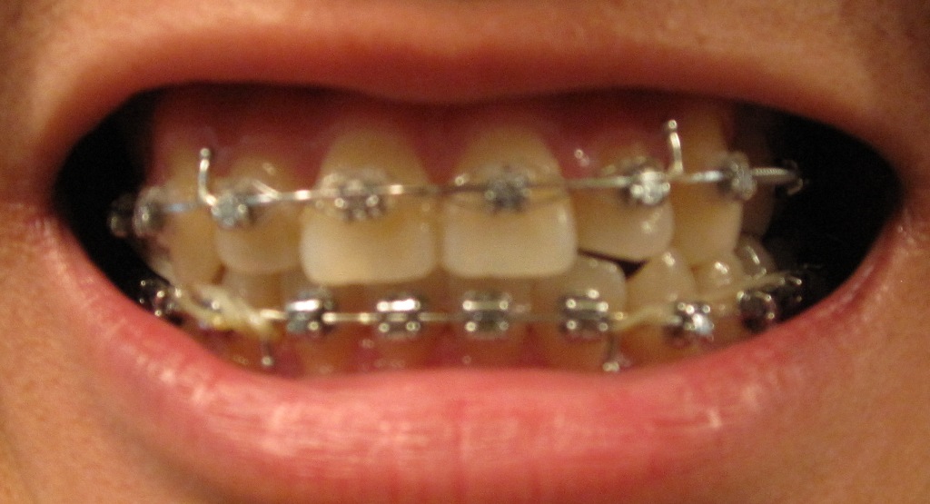 My Journey with the Damon Braces Week 61 with the Damon Braces
