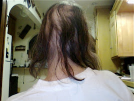 Back of my head hair loss, day 3