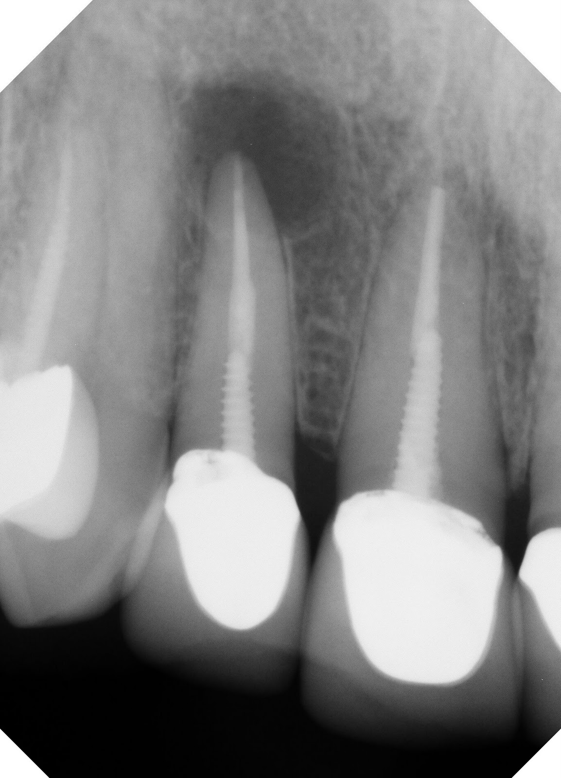 dental-x-ray-sensors-xdr-leading-the-way-digital-x-ray-system
