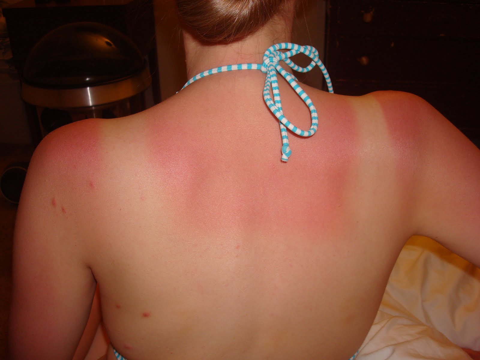 Hawadäre! Why Does A Sunburn Hurt So Much?