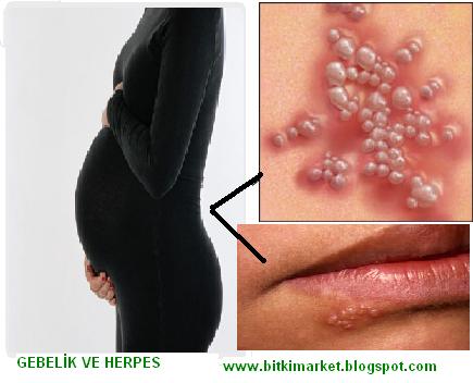 [GEBELİK+VE+HERPES.JPG]