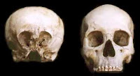 مقارنة بين جمجمة الإنسان (في اليمين) وجمجمة ستارتشايلد الغامضة (في اليسار)