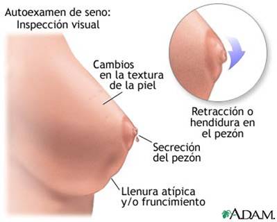 Enfermedad de paget de seno causas