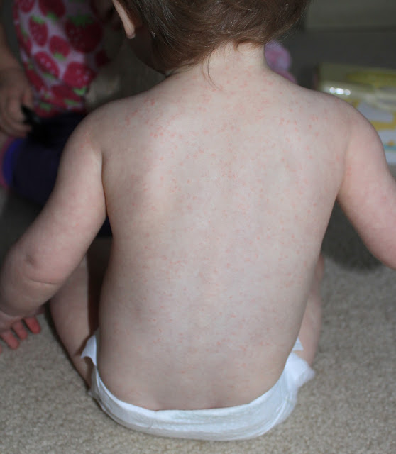 Allergic to Amoxicillin