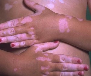 [300px-vitiligo.jpg]