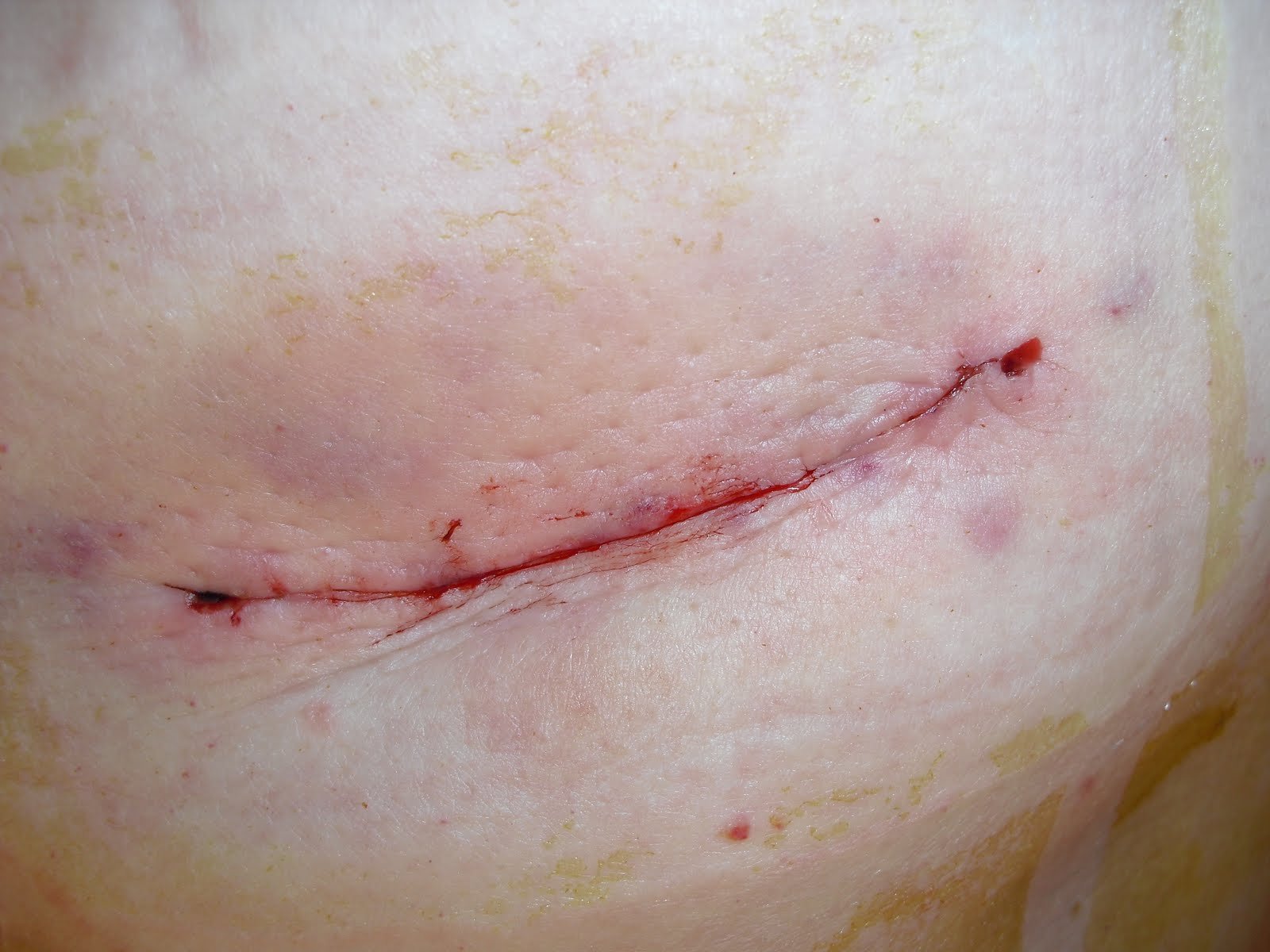 Post Surgery Incision Infection Signs | LIVESTRONG.COM