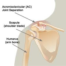 Therapy Concepts: Separated Shoulder