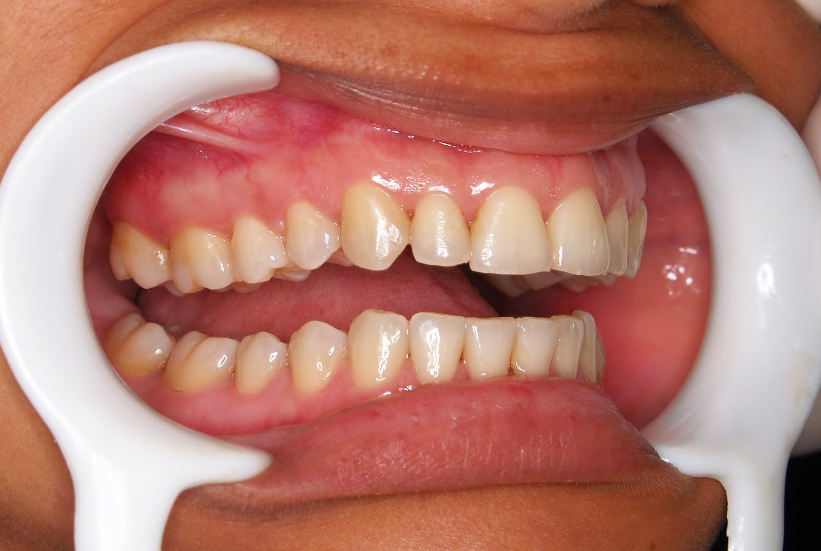 ANESTESIA BUCAL - Guía practica: TECNICA DE VAZIRANI Y AKINOSI