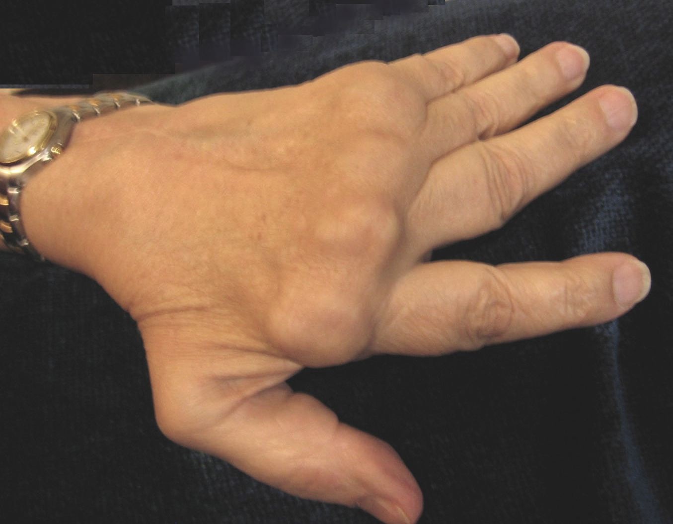 Rheumatoid Arthritis & Sjögren's Syndrome Help, Hints & Hindsight My