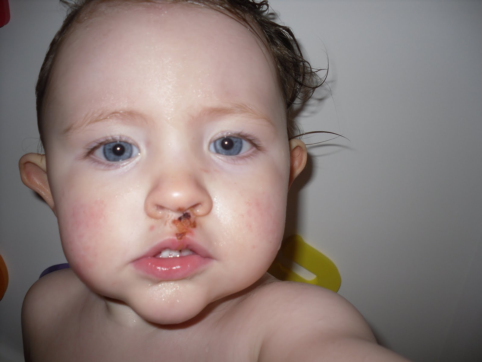 The Kelly Kids Caroline 20monthsFirst busted lip