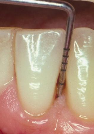 AHIPRODEC: Índice de Necesidad de Tratamiento Periodontal de la ...