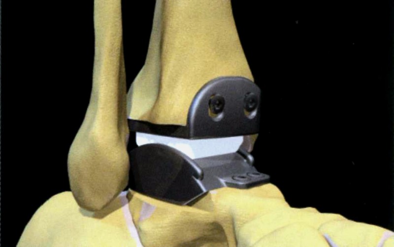 эндопротез голеностопного сустава инфинити. замена сустава стопы. замена сустава стопы. эндопротезирование таранной кости. артродезирование сустава пальца стопы.