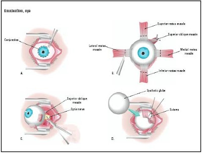 Enucleation evisceration and retinoblastoma Treatment 