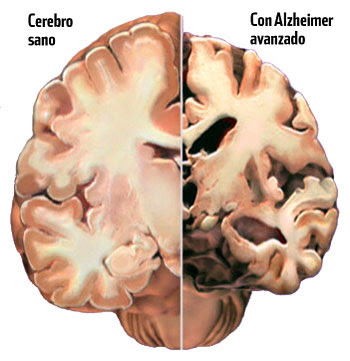 Resultado de imagen de enfermedad degenerativa