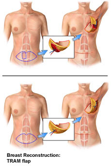 breast reconstruction tran flap Breast reconstruction tran flap