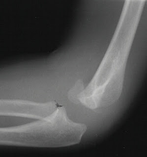 Life & Science: Bone Fractures!!!