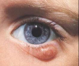 Chalizon puede causar infección ocular Chalizon puede causar infección ocular