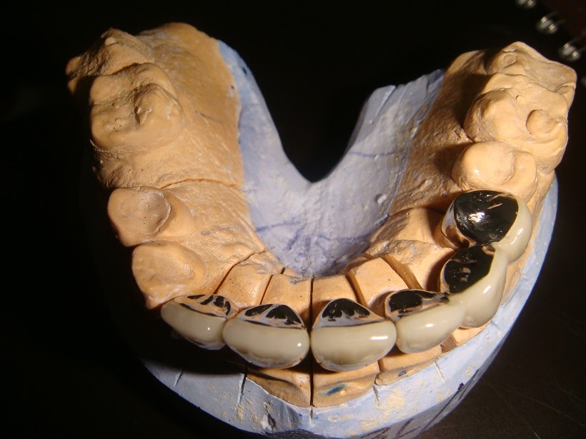 PUENTE FIJOS Laboratorio de Prótesis Dental Santos