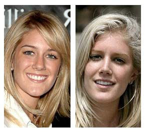 Heidi Montag Plastic Surgery Before And After Pictures