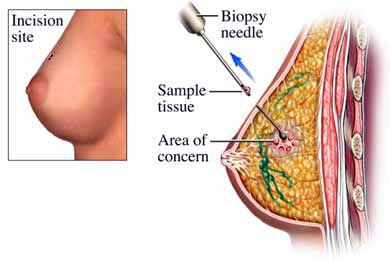 benign tumors Breast